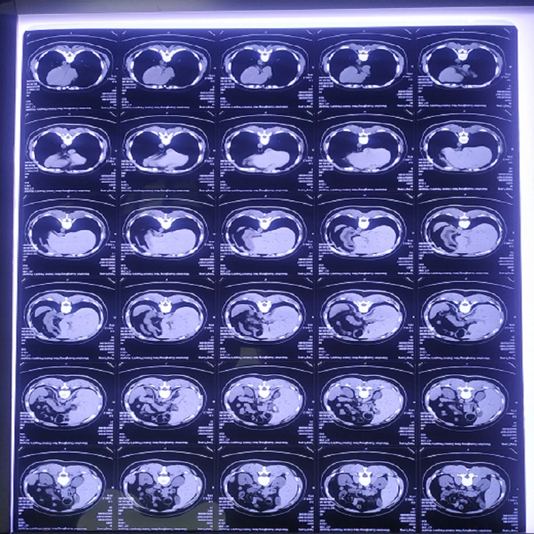 Medical X-ray Film-Inkjet-Single 14*17 Inch High-Resolution Medical Color Inkjet Printing Film
