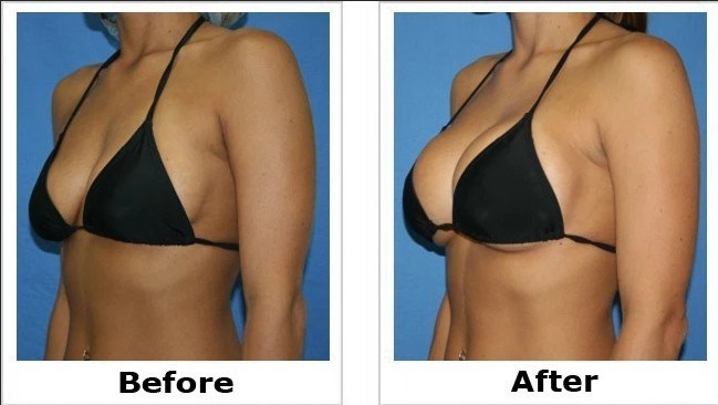 Skinject 20ml Hip/Breast Enlargement Dermal Filler