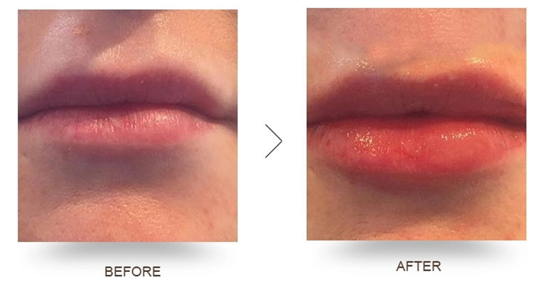Cross Linked Hyaluronic Acid Filler for Hip / Buttock Enlargement