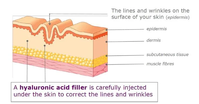 Cosmetic Sterile Hyaluronic Acid Gel Factory Directly Sale 1ml 2ml Hyaluronic Acid Injection Price to Buy