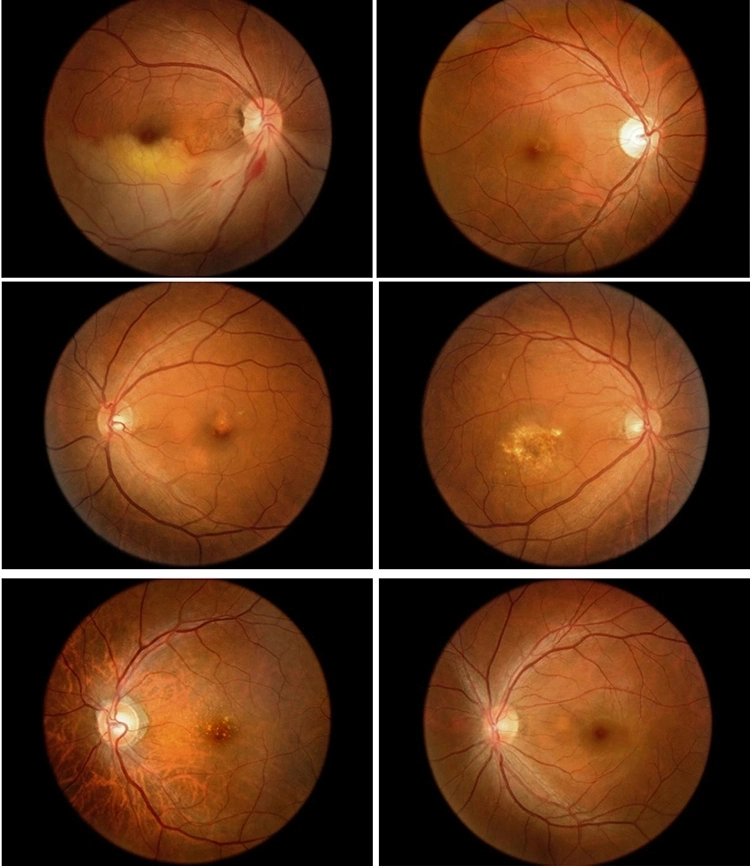 FDA Approved Aps-Ber Eye Digital Fundus Camera Price