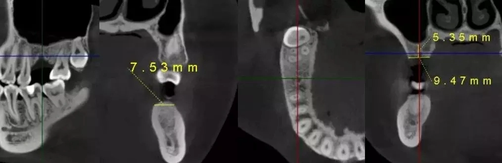 Hires 3D-Plus CE Professional Large Fov Dental 3D Cone Beam Computred Tomography Cbct