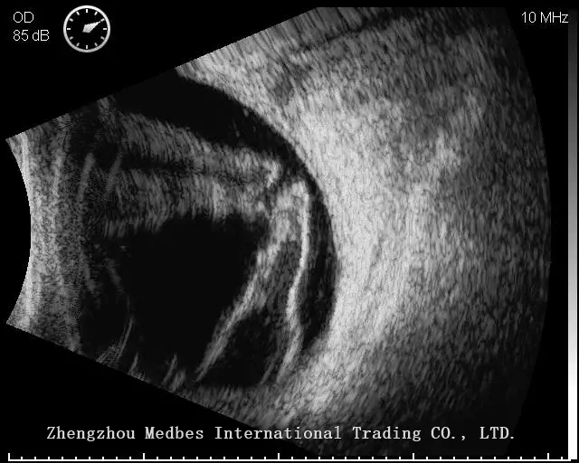 Ophthalmology Ultrasound Scanner MD-2300S