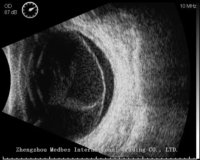 Portable B Scan Ultrasound a/B Scanner for Ophthalmology with Color Touch Screen
