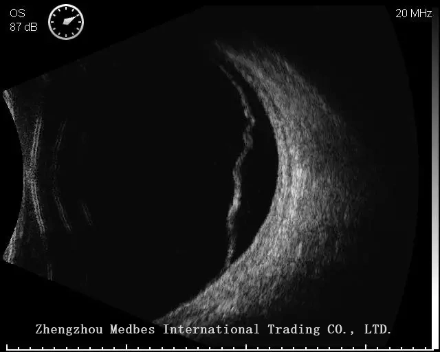 Portable B Scan Ultrasound a/B Scanner for Ophthalmology with Color Touch Screen