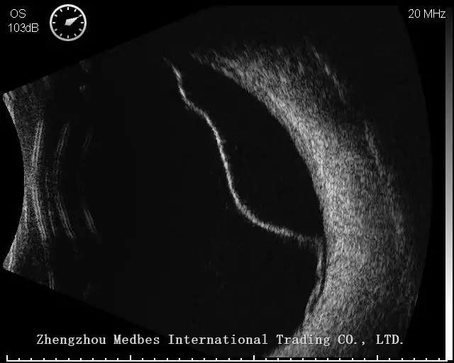 Portable B Scan Ultrasound a/B Scanner for Ophthalmology with Color Touch Screen