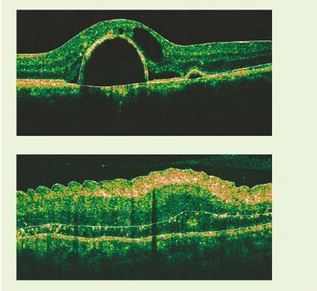 Ophthalmic Equipment Optical Coherence Tomography with Efficient 3D Analysis