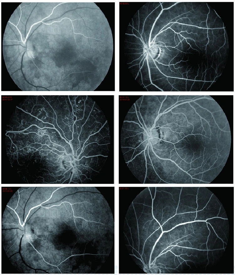 FDA Approved Aps-Ber Eye Digital Fundus Camera Price