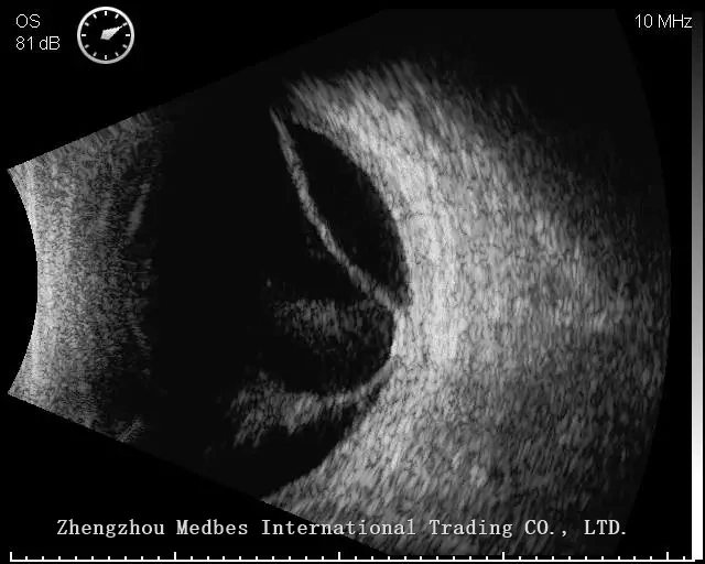 Portable B Scan Ultrasound a/B Scanner for Ophthalmology with Color Touch Screen