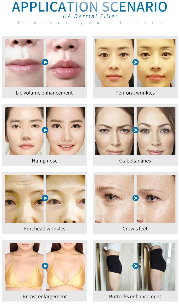 Eye/Cheek/Lip Plumper Hyaluronic Acid Surgery Filler Injections Cosmetic Grade Whosale