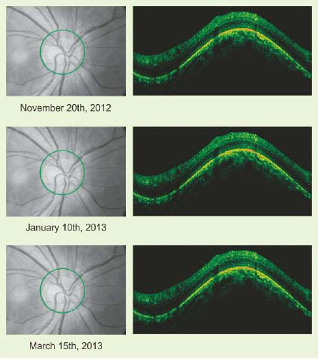 Ophthalmic Equipment Optical Coherence Tomography with Efficient 3D Analysis