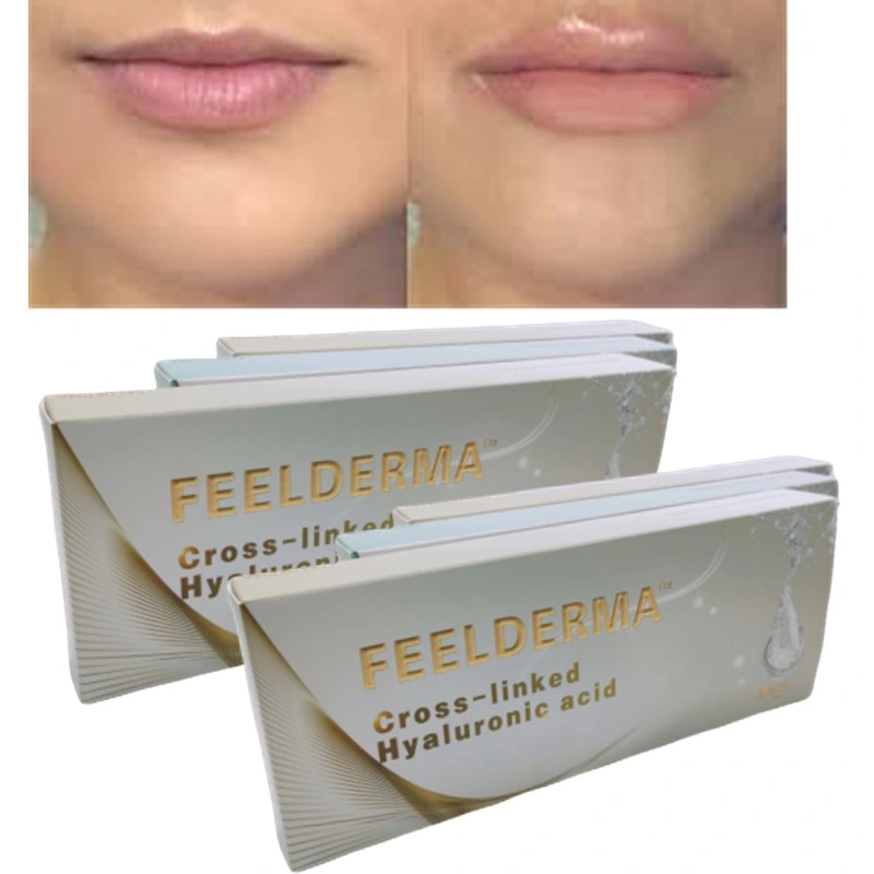 Dermal Filler Gel Injectable Hyaluronic Acid to Remove Deep Wrinkles Anti Aging for Clinic Plastic Surgery