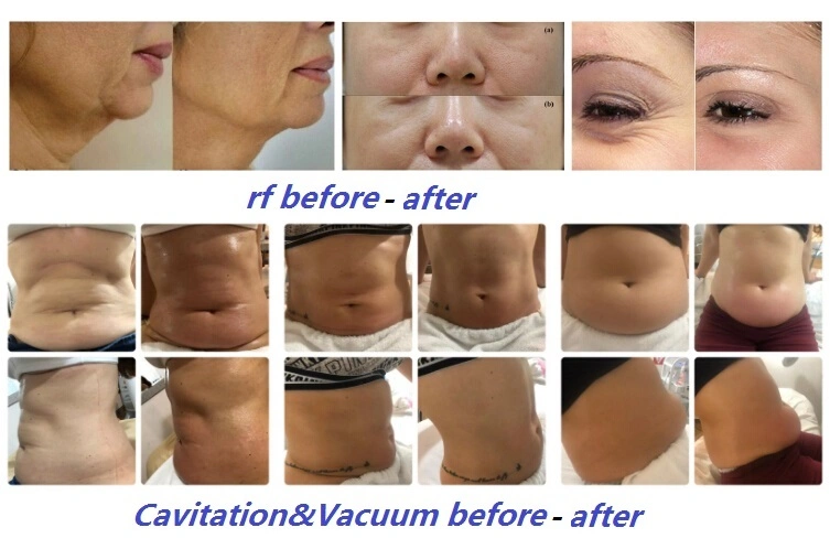 Weifang Huamei Ultrasonic Cavitation System RF Vacuum Weight Loss Medical Equipment Body Slimming Beauty Salon Equipment