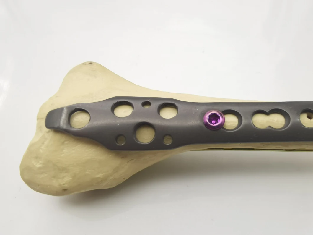 Hot Selling Orthopedic Implant Distal Radius Locking Plate with CE Certificate