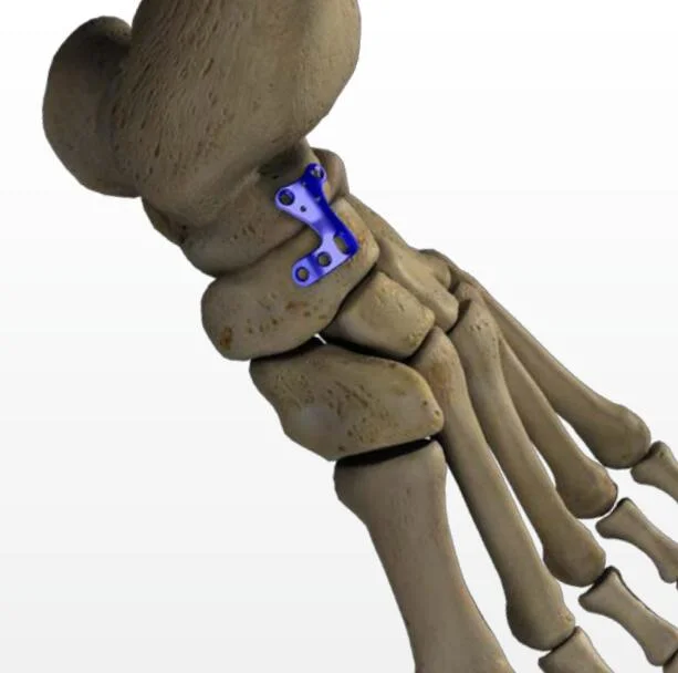 Orthopedic Locking Plate, Ankle Reconstruction Implant