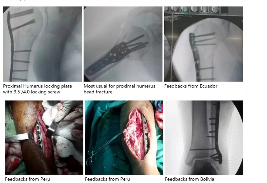 Orthopedic Instruments Trauma Plates Screws Surgical Screw Box Bone Instruments