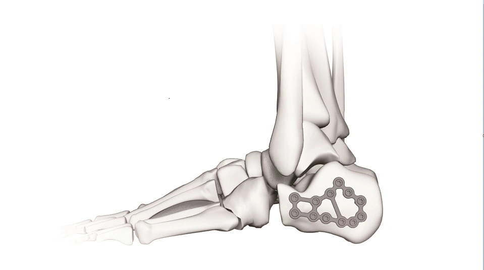 Calcaneus Locking Plate Orthopedic Calcaneal Implant Medical Calcaneous Bone Fracture