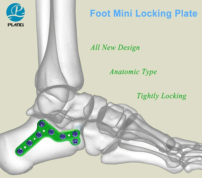 Orthopedic Calcaneus Foot Mini Locking Plate