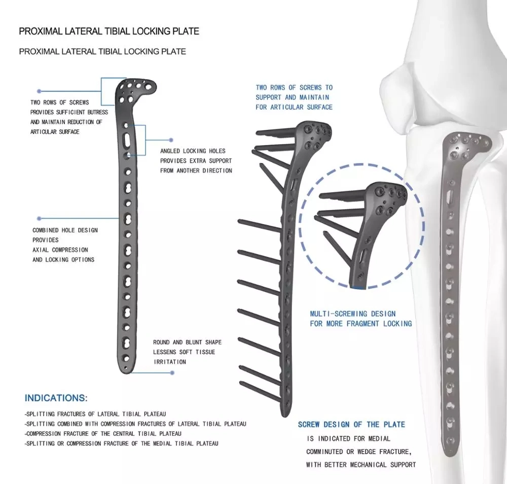 New Design Proximal Lateral Tibial Locking Plate, Titanium Orthopedic Implants