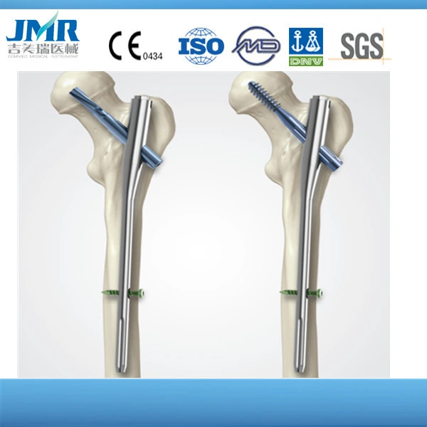 Expert Intramedullary Nail, Titanium Interlocking Nail, Trauma Plate, Gamma Nail