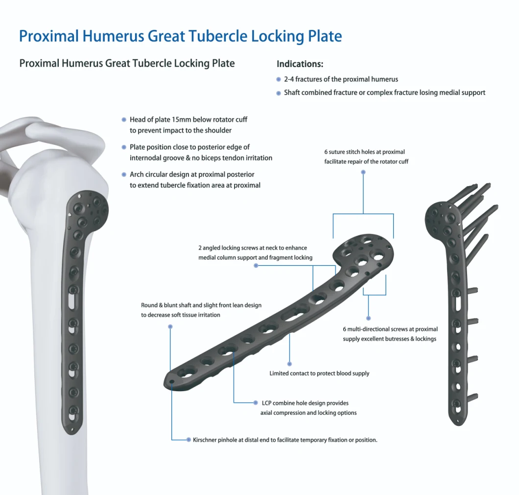 Locking Plate Proximal Humeral Greater Tubercle Orthopedic Trauma Implants