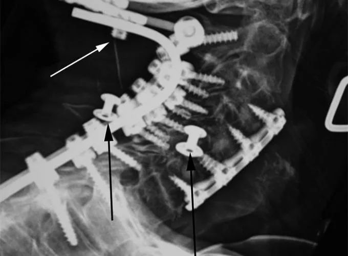 Posterior Cervical Internal Spine Fixation System, Spine Pedicle Screw Implant