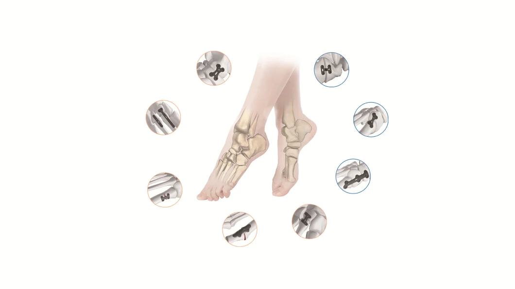 Canwell Medical Foot and Ankle Reconstraction Locking Plate System Instrument Set