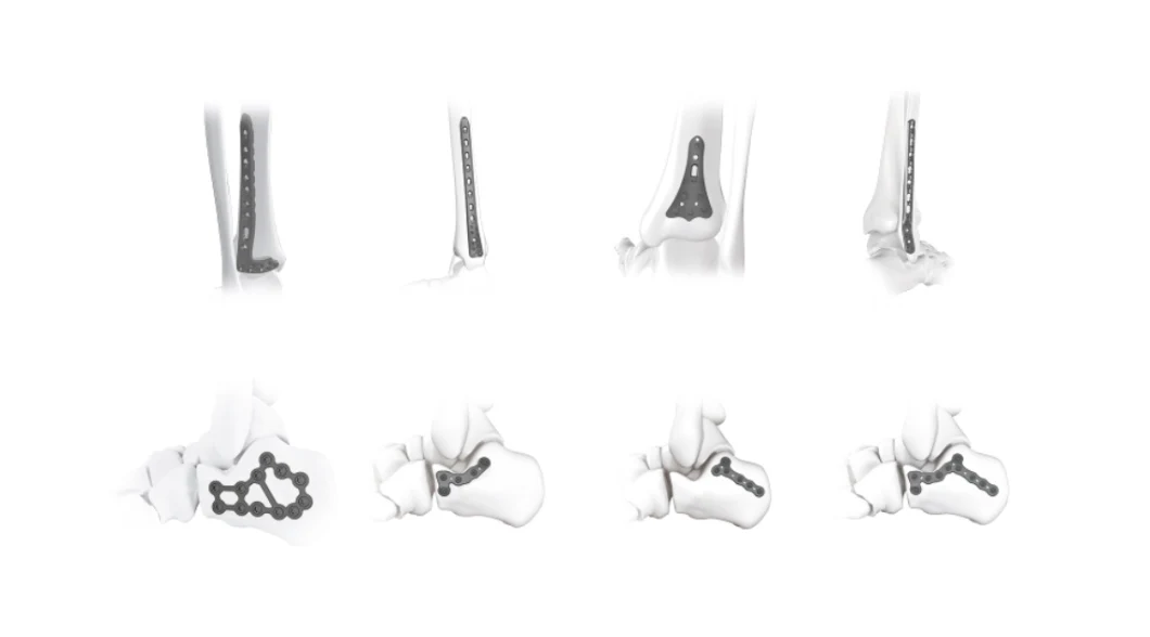 Calcaneus Locking Plate Orthopedic Calcaneal Implant Medical Calcaneous Bone Fracture