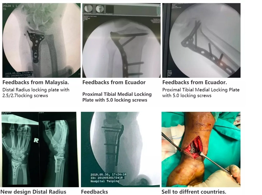 2.4 2.5 Orthopedic Implant Titanium Trauma Bone Distal Radius Locking Plates Screws