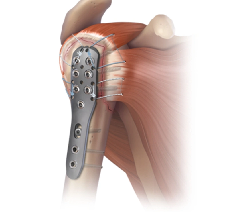 Multiaxial Humeral Proximal Orthopedic Implant Titanium Locking Compression Plates Trauma Bone Plate
