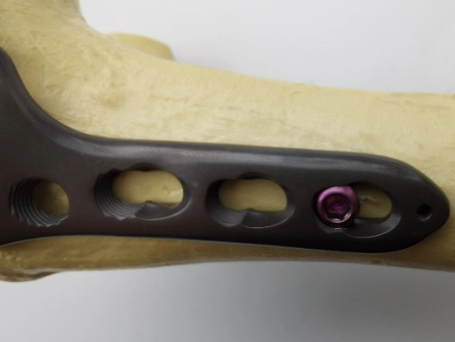 Orthopedic Plate Distal Femur Condyle Locking Plate