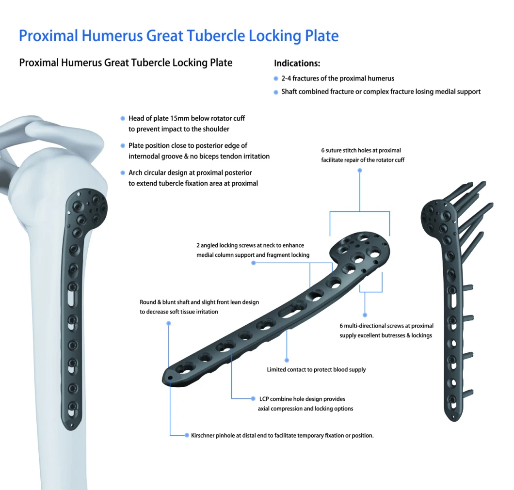 Surgical Humerus Locking Bone Plate, Titanium Orthopedic Implants