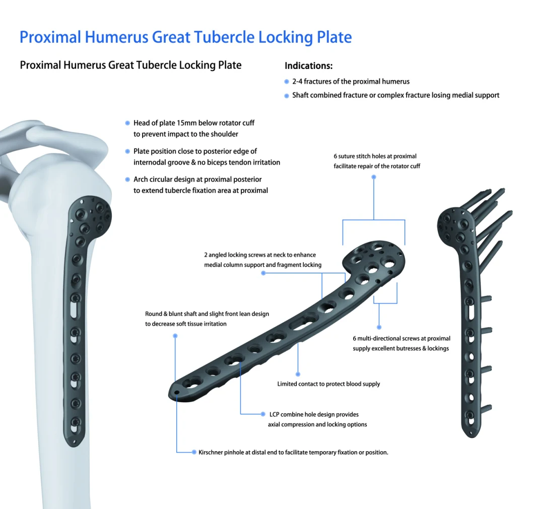 Proximal Humeral Locking Plate, Titanium Plate Humerus Locking Plate