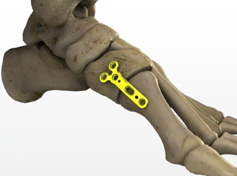Orthopedic Locking Plate, Ankle Reconstruction Implant