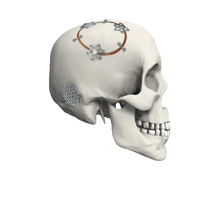 Orthopedic Implant Skull Surgical Drainage Cranial Interlink Titanium Plate