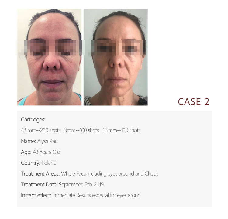 Hifu 4D Skin Tightening Wrinkle Remover 100000 Shots Face Lifting Body Slimming 25000 Shots Beauty